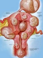 Интрамуральная миома матки