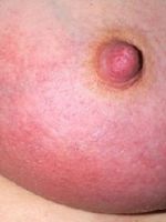 Мастит при грудном вскармливании - симптомы 