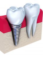 Имплантация зубов – противопоказания и возможные осложнения