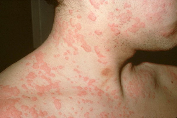Аллергия Как Она Выглядит Фото