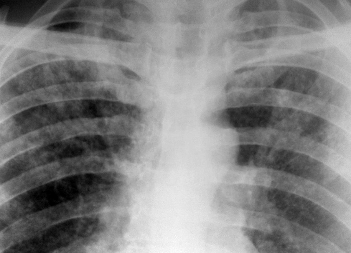 Диссеминированный туберкулез легких заразен или нет