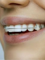 Пластины для выравнивания зубов
