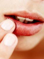 Простуда на губах – как лечить быстро?