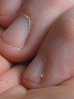 Как убрать заусенцы на пальцах? 