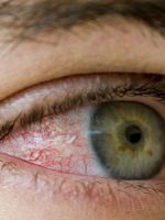 Покраснение глаза – причины и лечение