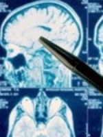 Чем опасна ретроцеребеллярная арахноидальная киста головного мозга?