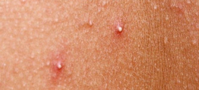 Мелкие пятнышки или прыщики появляющиеся на теле при некоторых болезнях thumbnail