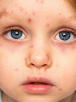 Герпес у детей – типы, симптомы и лечение самых частых типов вируса