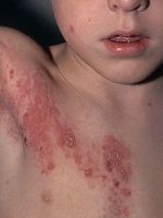 Диета при атопическом дерматите у детей