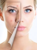 Угревая сыпь – как быстро и эффективно вылечить кожу?