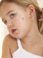 Атопический дерматит у детей – как его распознать и правильно лечить?