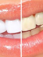 Отбеливание зубов – как отбелить зубы в домашних условиях или в стоматологии?