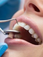 Лечение кариеса – лучшие способы, которые предлагает стоматология сегодня