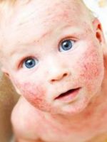 Эмоленты при атопическом дерматите у детей – список и правила применения