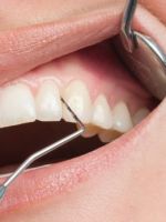 Зубной камень – как избавиться в домашних условиях и у стоматолога?