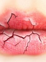 Обветрились губы – как вылечить за 1 день?