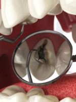 Пульпит зуба – причины и современное лечение