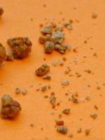 Микролиты в почках – что это такое, и как лечить микролитиаз?