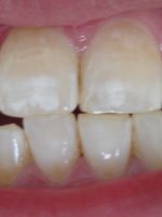Гипоплазия эмали – как сохранить свои зубы?