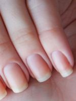 Гранулема ногтя – 4 главных причины и лучшие способы лечения