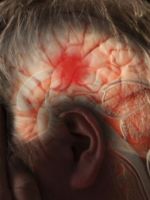 Сифилис головного мозга – все признаки и последствия нейросифилиса
