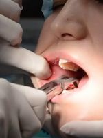 Удаление зуба мудрости на нижней челюсти – как проходит операция, и что делать после?