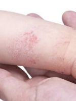 Эксфолиативный дерматит – причины и лечение синдрома ошпаренной кожи