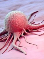 Болезнь рак – виды злокачественных опухолей и современное лечение