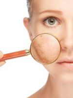 Пигментные пятна на лице – как избавиться с помощью косметики и современных процедур?