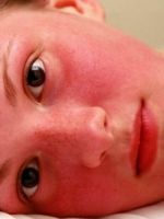 Эритремия – чем может быть опасно красное лицо?
