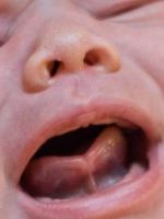 Короткая уздечка языка у новорожденного ребенка – нужна ли операция?