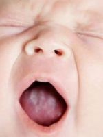 Молочница у новорожденных во рту – почему возникает и как лечить кандидоз у малыша?