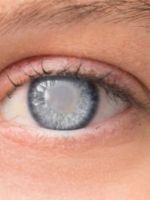 Глаукома – симптомы, которые важно выявить как можно раньше