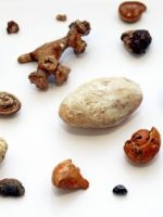 Камни в почках – причины, симптомы и лечение у женщин и мужчин