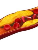 Повышенный холестерин – когда и как нужно снижать показатель?