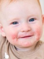 Аллергический дерматит у детей – что делать для лечения и профилактики?