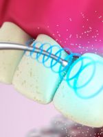 Удаление зубного камня ультразвуком – как проводят процедуру?