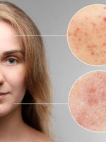 Заболевания кожи лица – 7 видов патологий