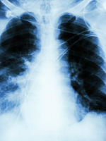 Пневмония без симптомов – как вовремя распознать угрожающую болезнь?