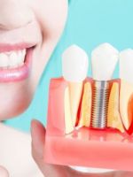 Импланты зубов – характеристика всех видов протезов и методы имплантации