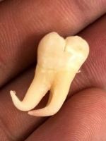 Зуб мудрости – строение, особенности роста, частые заболевания и лечение