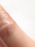 Трещина на пальце руки – симптомы, причины, психосоматика