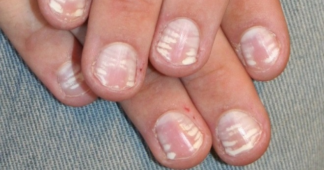 White spots on the nails - what does the body signal?