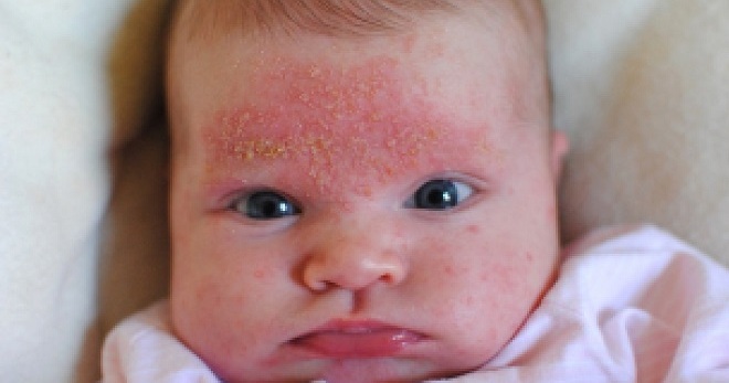 Потница у новорожденных – как не перепутать с аллергией и быстро устранить сыпь?