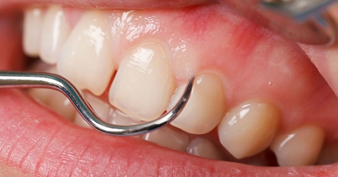 Ретракция десны – о чем не всегда расскажет стоматолог?