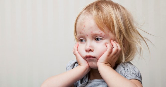 Может ли ребенок заболеть краснухой от привитого ребенка thumbnail
