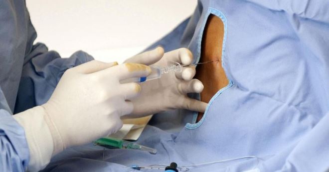 Эпидуральная анестезия при кесаревом сечении – все особенности обезболивания