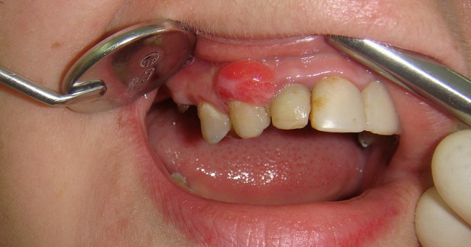 Киста зуба – причины и 3 метода лечения