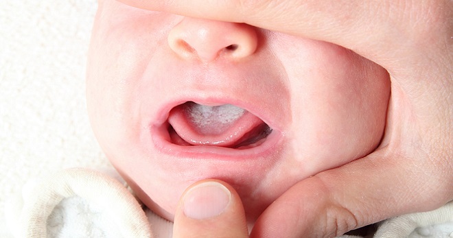 Белый налет на языке у ребенка 1 год причины