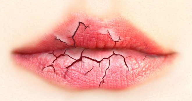Обветрились губы – как вылечить за 1 день?